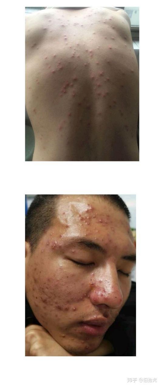成人长水痘痊愈过程视频,成人长水痘全程治愈过程揭秘